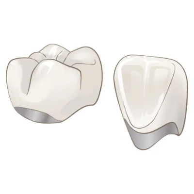 メタルセラミック